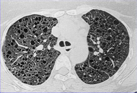Chest Ct Scan Of Patient With Lymphangioleiomyomatosis Showing Multiple