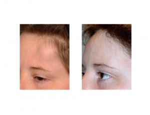 Case Study Removal And Reconstruction Of A Large Forehead Osteoma