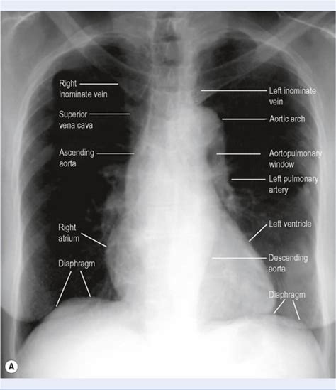 Evaluation of a chest radiograph may appear to be simple, but is in fact a complex task requiring careful observation, sound understanding of chest anatomy, and knowledge of the principles of physiology and pathology. 2: Respiratory system | Anesthesia Key