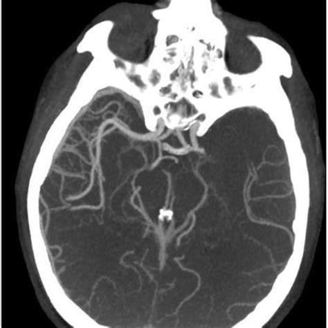 Ct Head Demonstrating Left Middle Cerebral Artery Occlusion Red Arrow