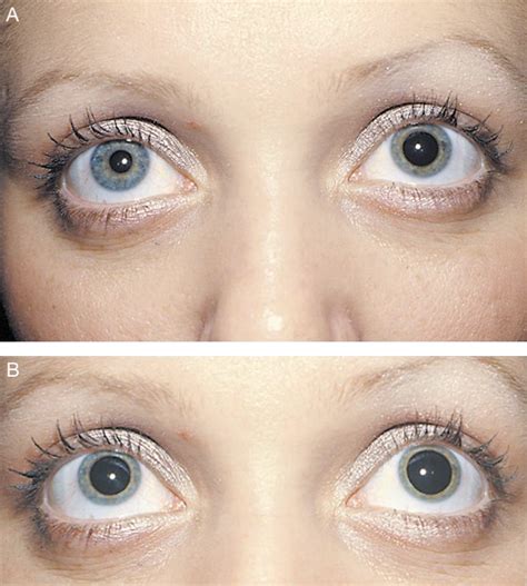 Horner Syndrome Pharmacologic Diagnosis Ophthalmology Review