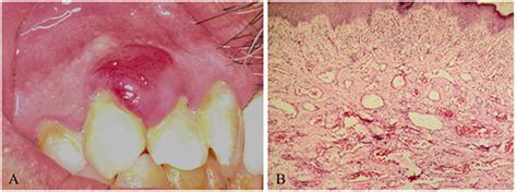 Morphological And Histological Views Of Pyogenic Granuloma A Clinical