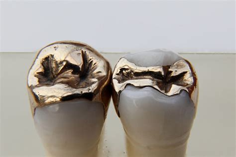 What Are Dental Inlay And Onlay Globaldentalpro