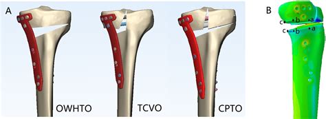 Combined Proximal Tibial Osteotomy For Varus Osteoarthritis Of The Knee