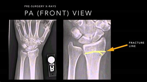 Wrist Fracture X Rays Youtube