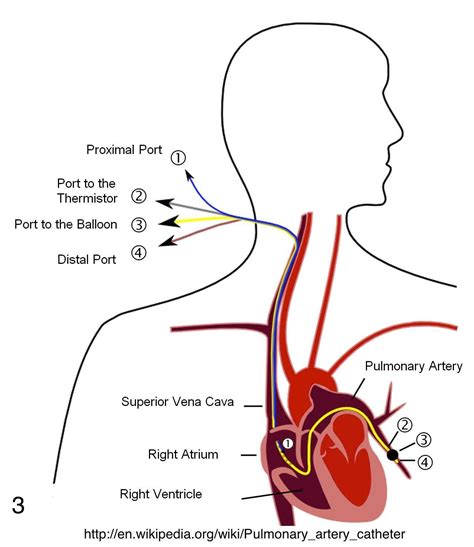 These medical abbreviations are commonly used in hospital, medical, and dental records. Pulmonary Artery Catheterization (Swan-Ganz Catheter ...