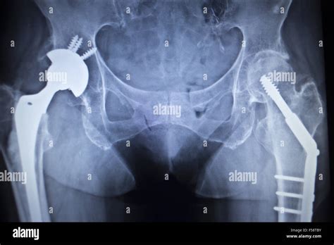 X Ray Scan Image Of Hip Joints With Screw And Plate Orthopedic Hip
