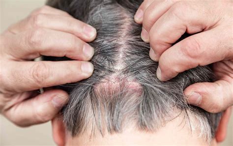 Scabs On Scalp Causes Diagnosis And Treatment