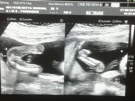 Boy Or Girl 20 Week Ultrasound Babycenter