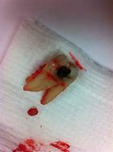 Photos of Dental Staph Infection