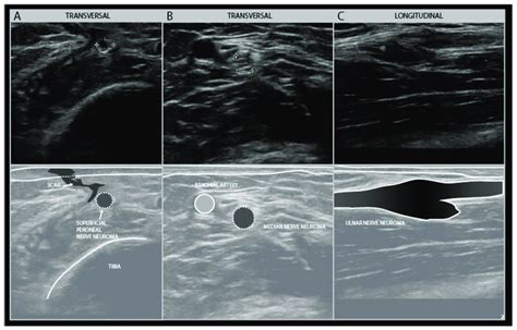 Examples Of Traumatic Neuroma In Continuity Transverse View Of A Small