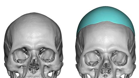 Custom Skull Heightening Implant Design Front View Dr Barry Eppley