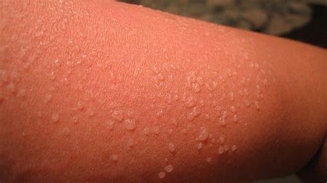 This sunburn happens and tends to clog sweat pores and makes them turn into sunburn blisters on the. How to get Rid of Sunburn Blisters | sunburn treatment ...