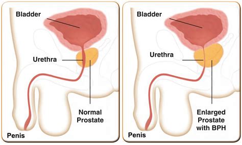 Urolift Procedure Bph The Urology Group Of Virginia