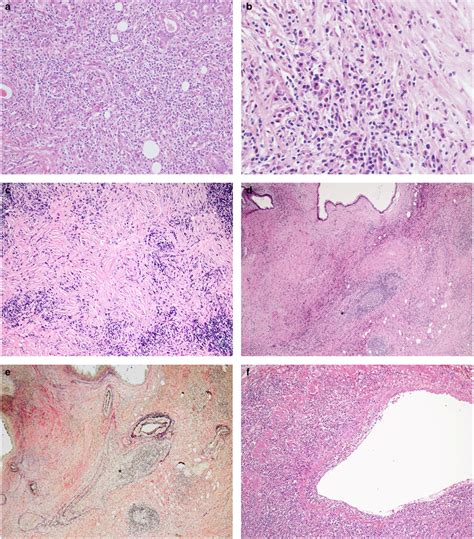 Characteristic Histological Features Of Igg4 Related Disease A Download Scientific Diagram