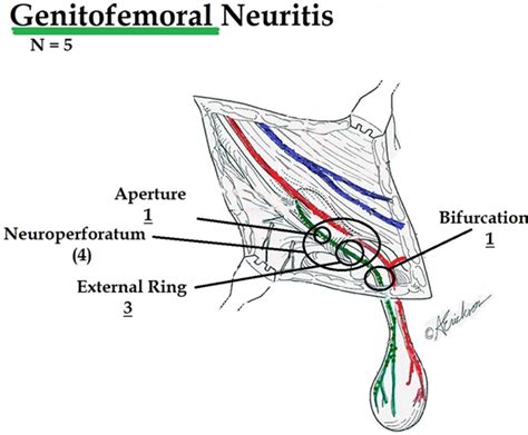 Inguinal Neuritis in Open Recurrent Hernia Repair