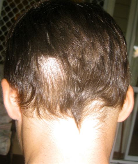 Bumps On Head After Haircut Which Haircut Suits My Face