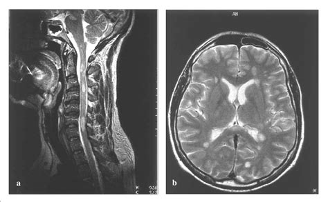 A T2 Weighted Sagittal Mr Image Of Cervical Spine Multiple