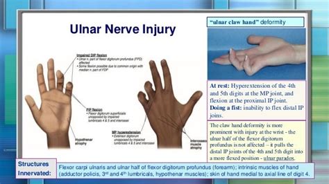 Ulnar Nerve Hand Deformity