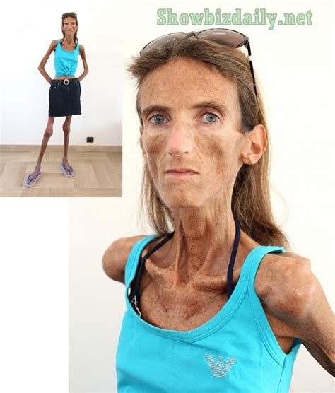 Valeria Levitin Extremely Anorexic Model And Thinnest Woman In The World Enewsdaily