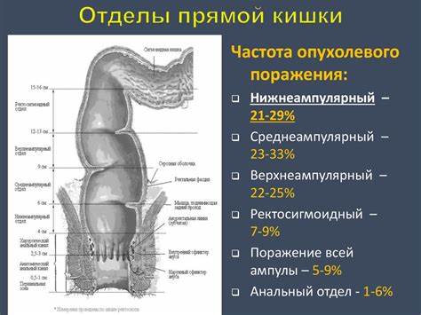 Хирургическое лечение рака нижнеампулярного отдела прямой кишки Картинка - Хирургическое лечение рака нижнеампулярного отдела прямой кишки