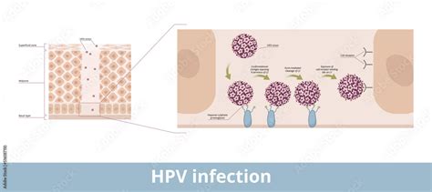 HPV Infection Process Of Human Papillomavirus Infection Caused By A