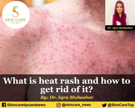 What Is Heat Rash And How To Get Rid Of It In Summer