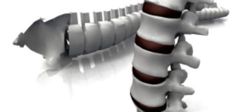 How Does An Interbody Cage Work During Spinal Fusion Surgery