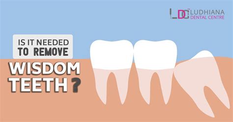 How to relieve wisdom tooth pain. #dentalclinic #oralhealth #teethwhitening #dentalhealth # ...