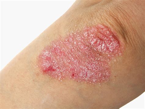 Psoriasis Border Compounding Pharmacy