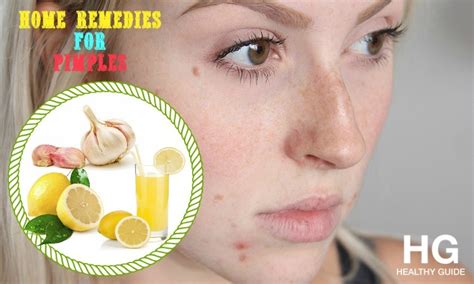 53 Best Natural Home Remedies For Pimples On Chin Face Nose And Back