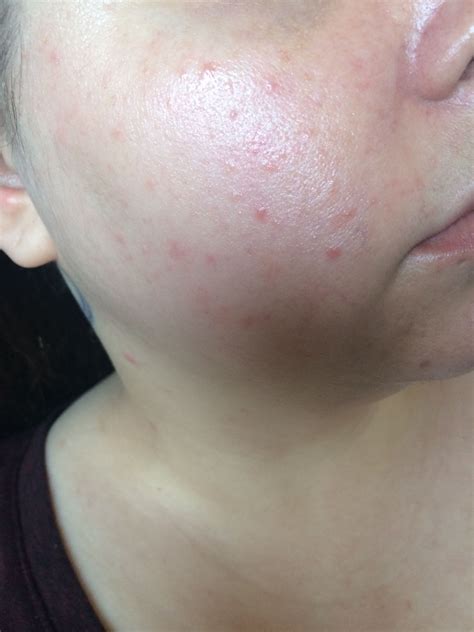 Skin Concerns Cant Get Rid Of These Red Bumps On My Cheeks And Not