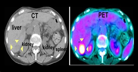 You will need to lie you will be given a radioactive injection prior to your scan and this will highlight areas in the body that are abnormal. PET-CT Scan | Nuclear Medicine | SRMS FIMC Lucknow ...