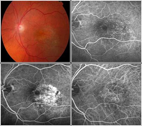 Guidelines For The Management Of Neovascular Age Related Macular
