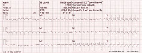 There are four main types: Treating Supraventricular Tachycardia with Adenosine