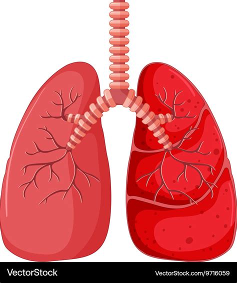Lung Diagram With Pneumonia Royalty Free Vector Image