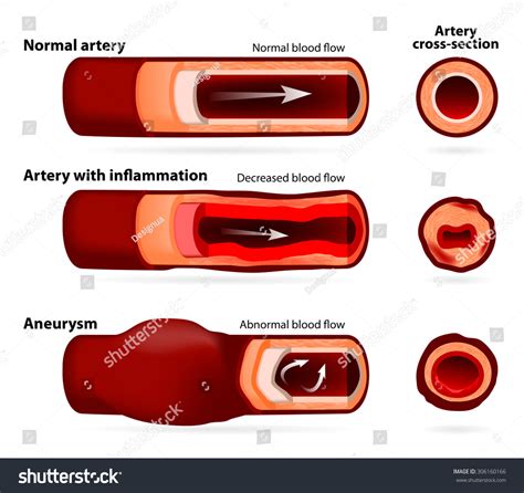 Normal Artery Inflamed Narrowed Artery Artery Stock Vector Royalty