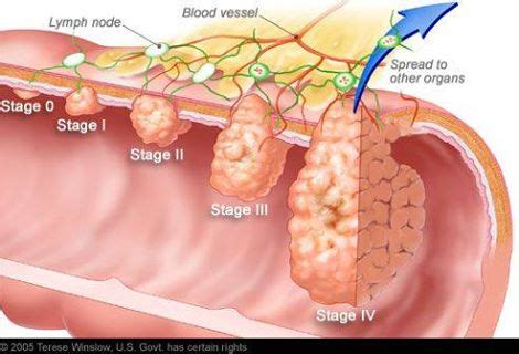 Staging can also help give your doctor an idea of what kind of outcomes you can expect (prognosis). Stage 4 Colon Cancer | Spooky2 Reviews