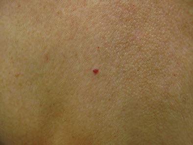 They should also not cause you any problems in terms of itchiness or inflammation, but they may bleed if they are scratched, knocked or rubbed excessively. Angioma Treatment | Norris Dermatology & Laser Northwest Portland