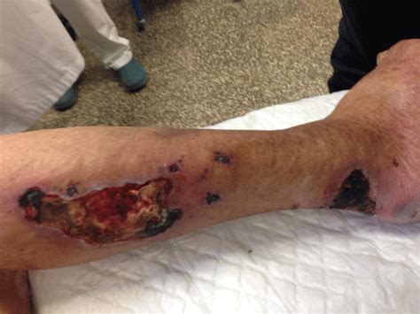Calciphylaxis In A Hemodialysis Patient Hot Sex Picture