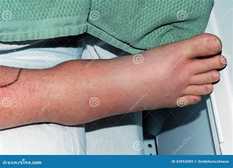 Staph Infecton Stock Image Image Of Outline Sick Foot 43953089