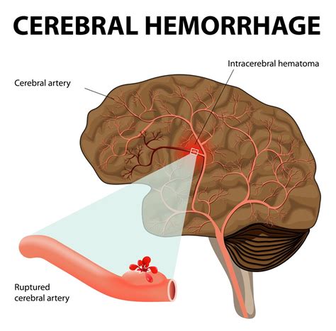 Hemorragia parenquimatosa cerebral conheça os sintomas Medway