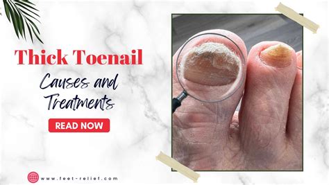 Thick Toenail Causes And Treatments Feet Relief