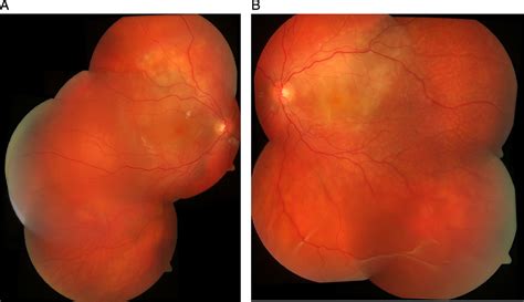 Bilateral Serous Retinal Detachment British Journal Of Ophthalmology
