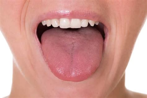 What Does A Healthy Tongue Look Like Pictures Issues Acacia Ridge Family Practice