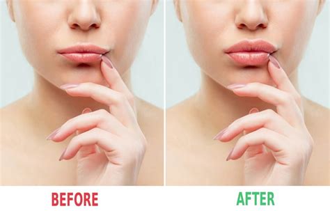 Relaxing Your Upper Lip With A Botox Lip Flip Siti Med Spa