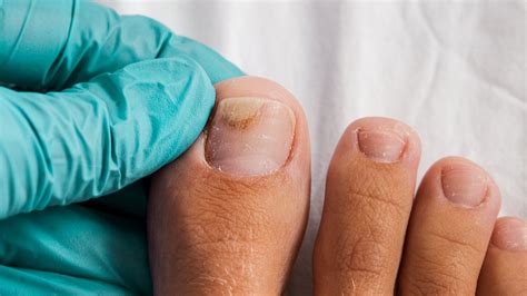Why Are My Nails Peeling Causes Of Flaking Peeling Nails Nail Repair Gel Toenail Fungus