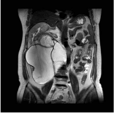Figure 1 From Treatment Of Lymphatic Leakage After Retroperitoneal