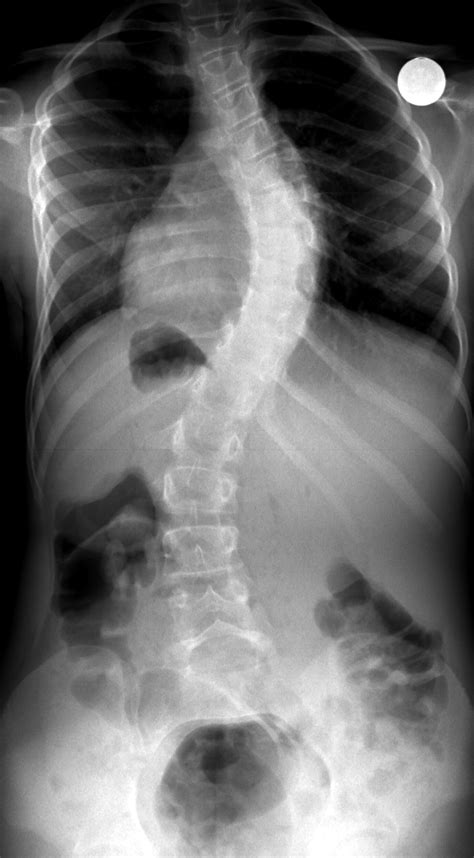 Spine Scoliosis X Ray Hot Sex Picture