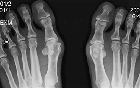 Radiograph of painful bilateral bipartite medial sesamoids ...